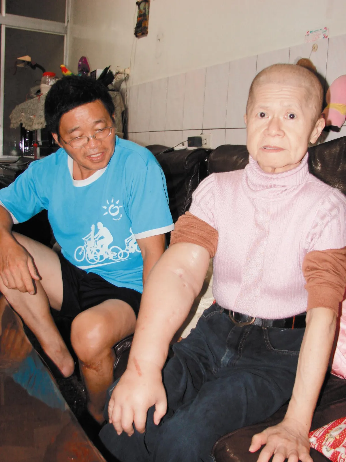 無腎臟 奇蹟存活11年