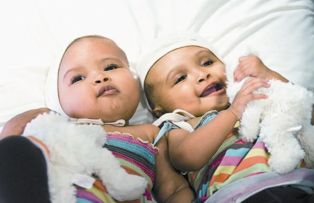 連體女嬰 分割成功