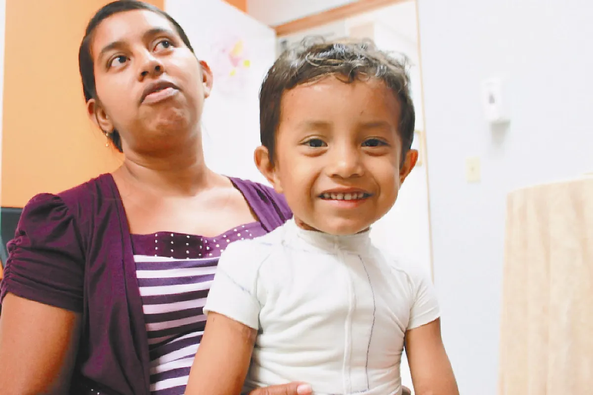 中美洲6000燒燙傷兒童  穿改良壓力衣復健 笑了