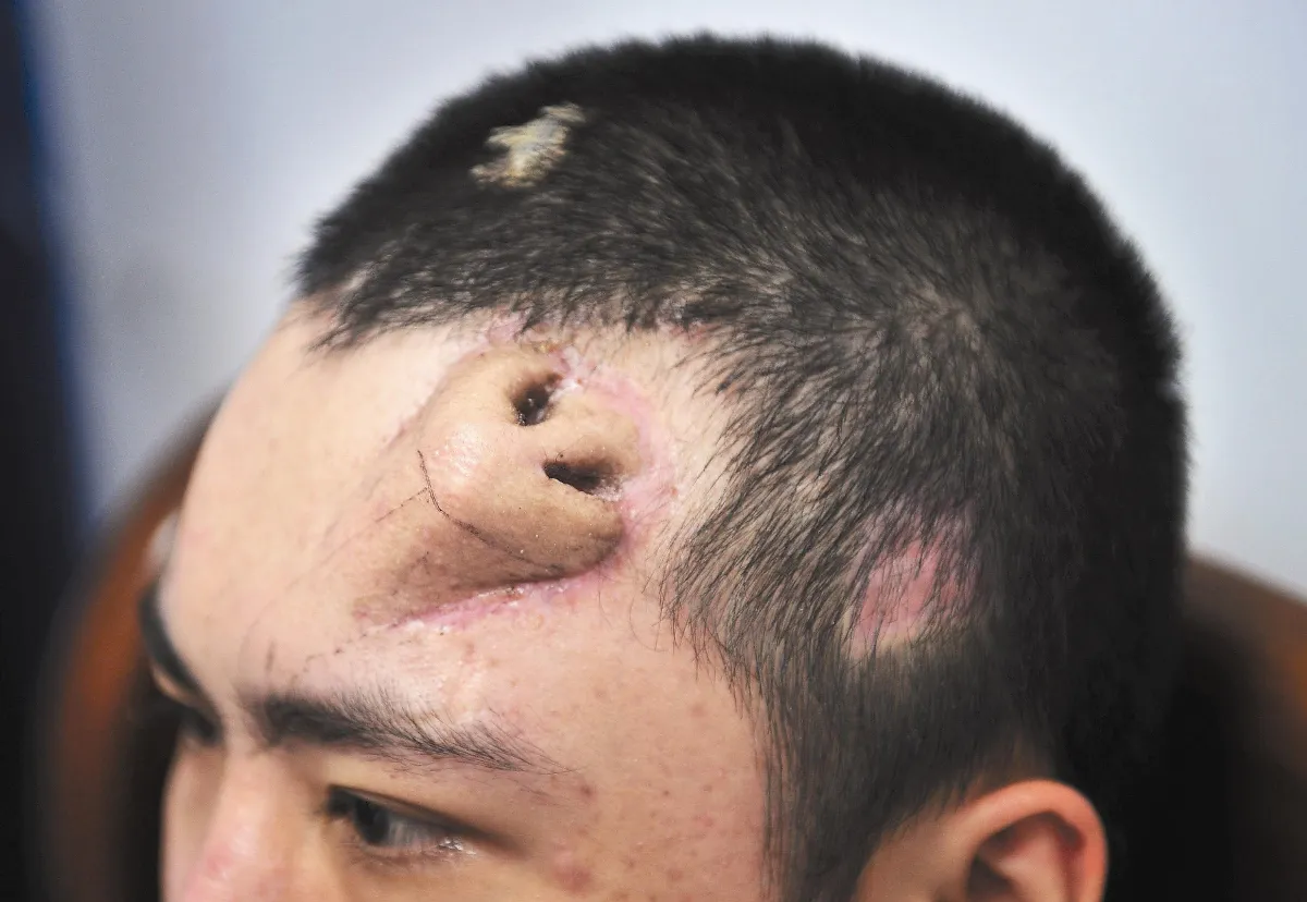 額頭種出新鼻子