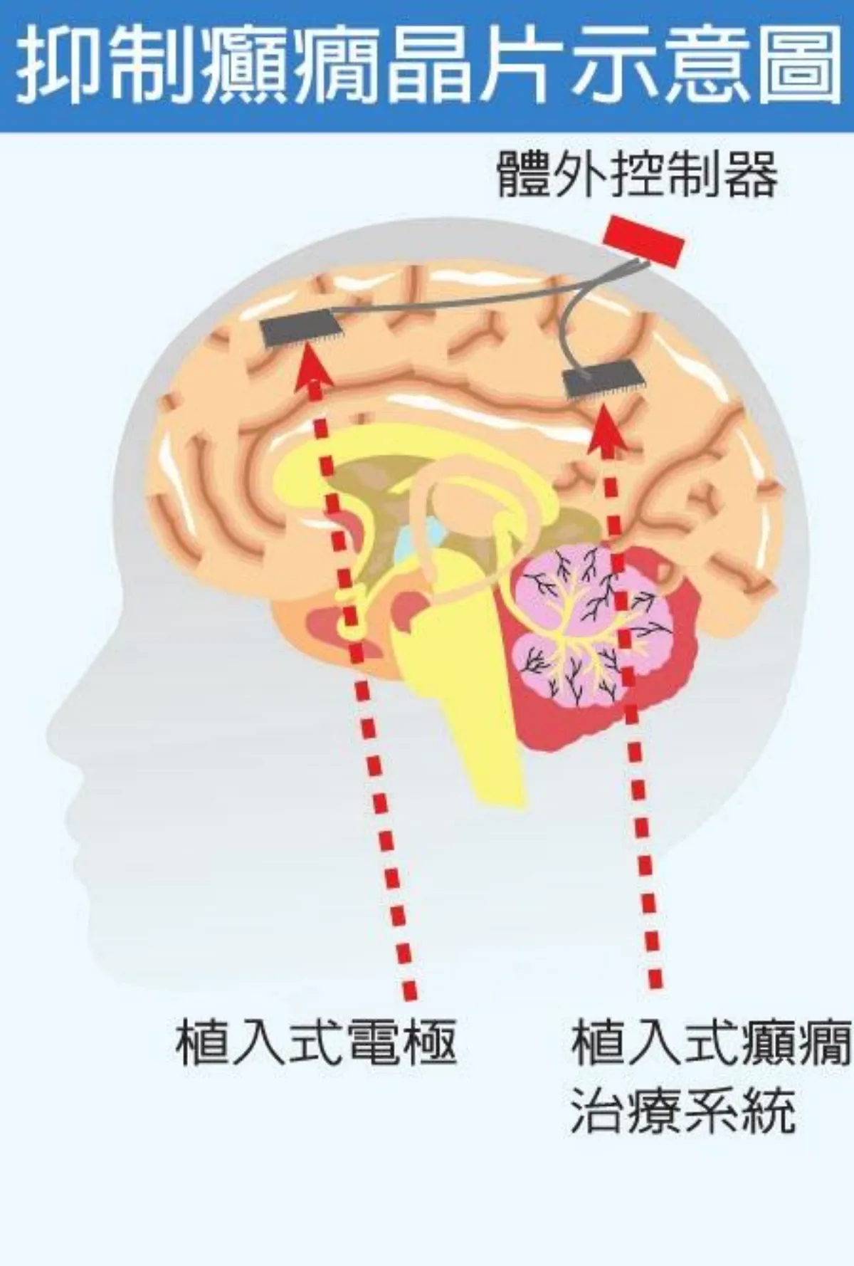癲癇治療晶片植入腦0.8秒奏效