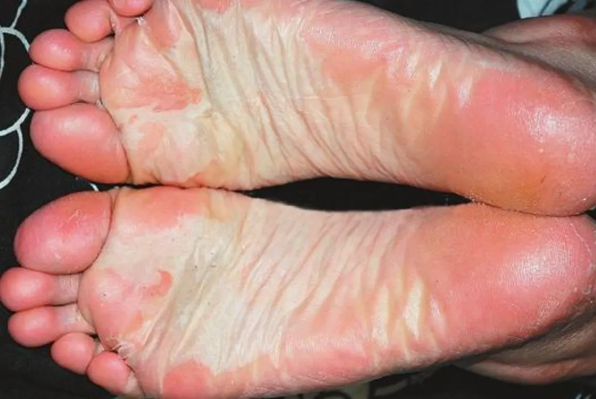 【皮膚小百科】 剝落性角質溶解症 壓力造成