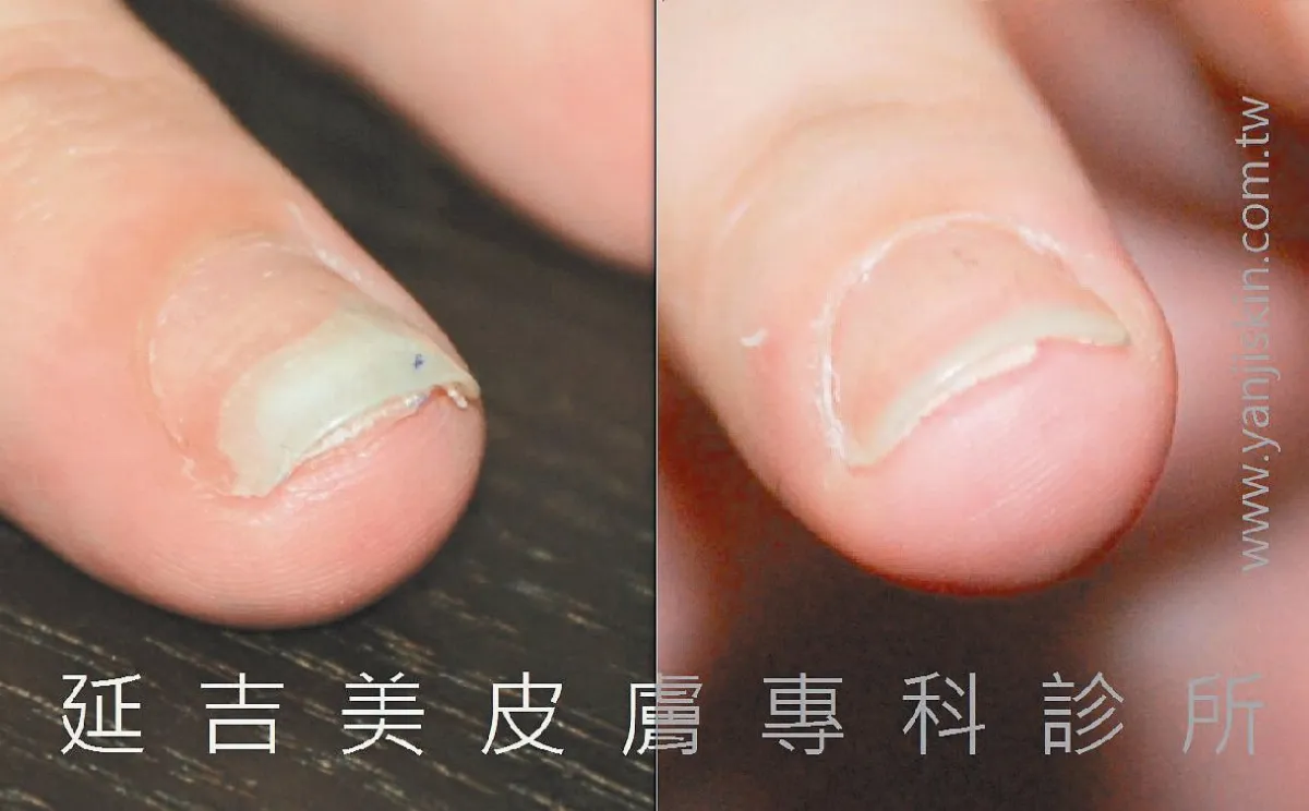 【皮膚小百科】 甲床剝離 不等於灰指甲