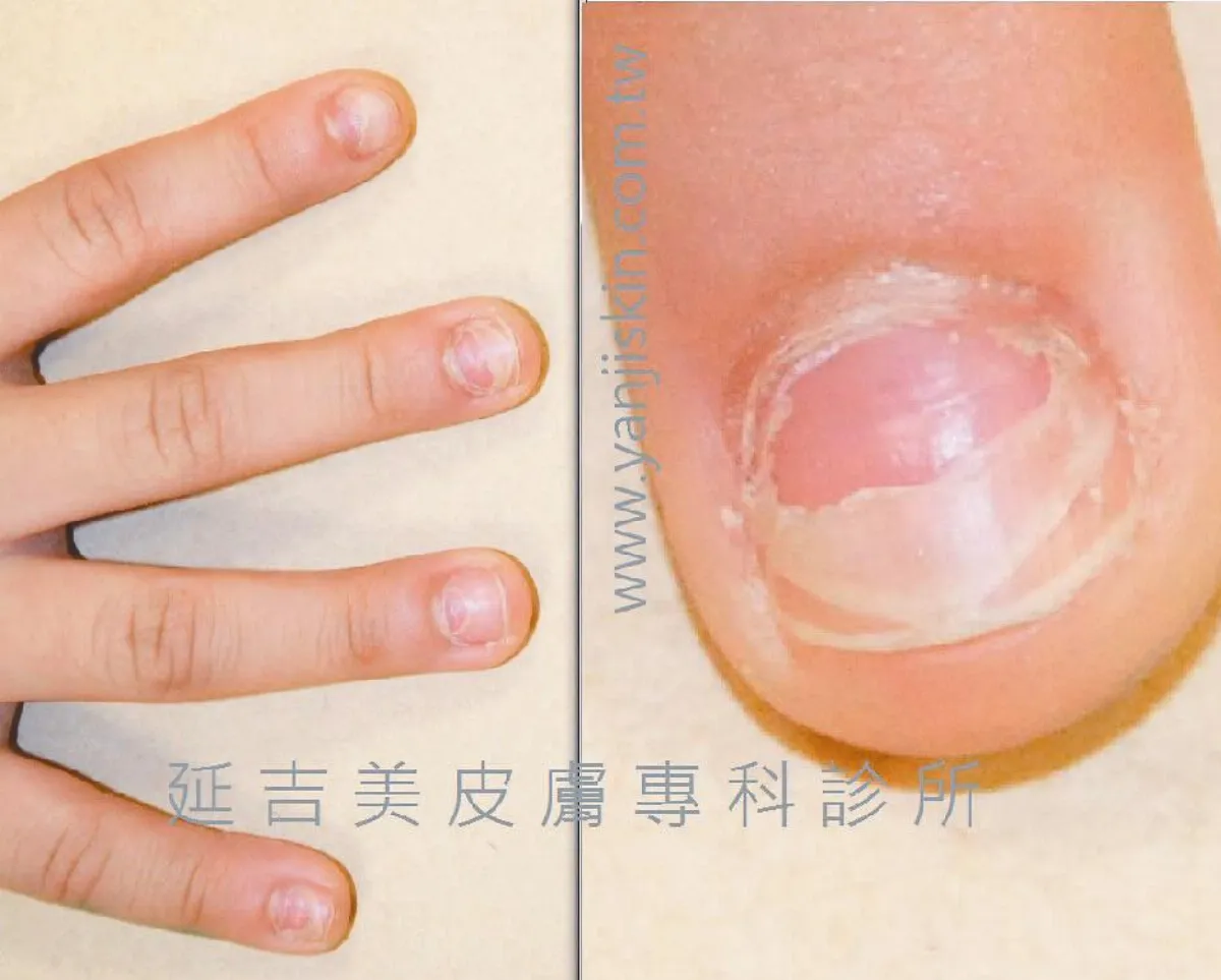 【皮膚小百科】 手足口病造成脫甲病 不需治療