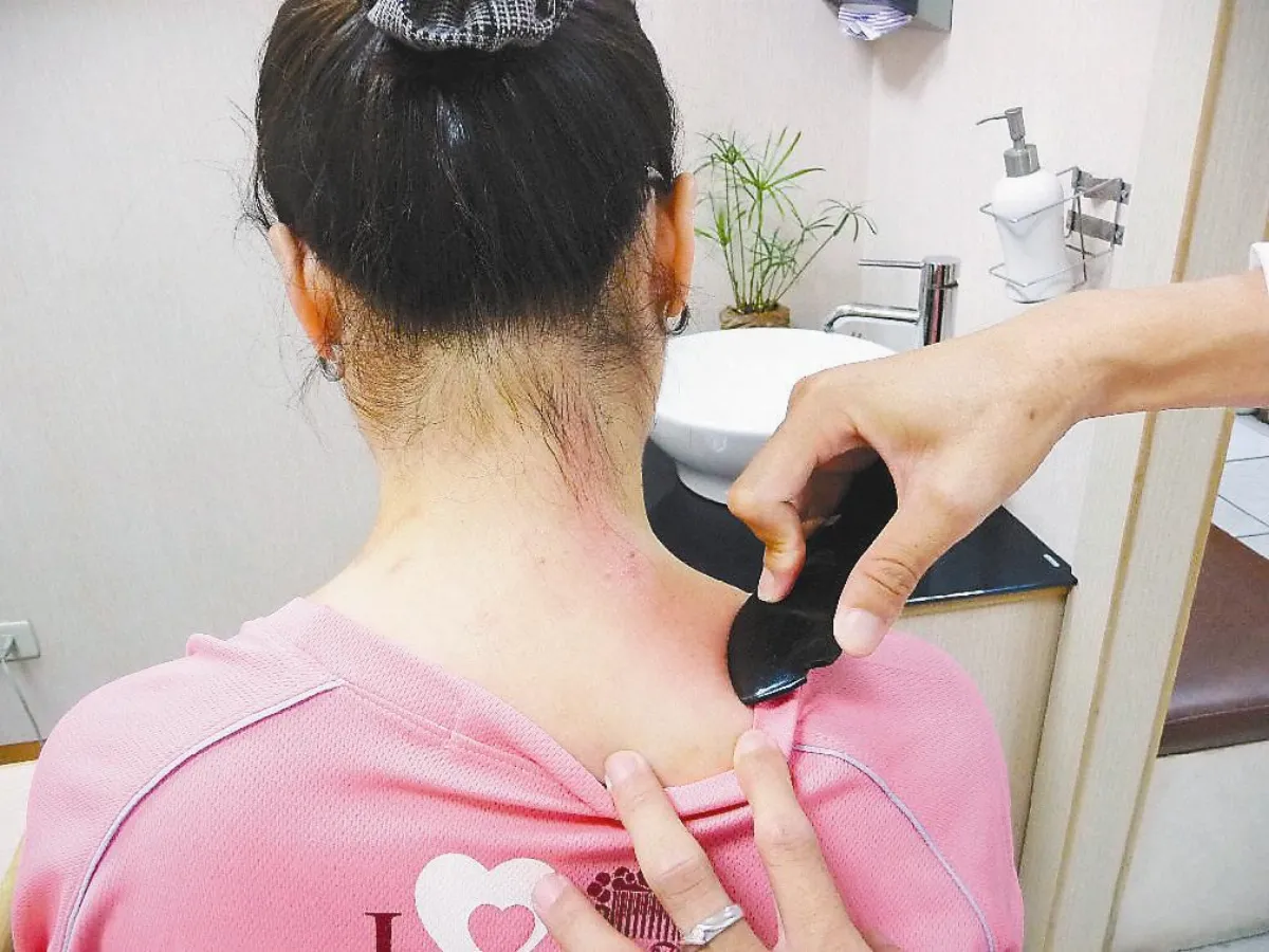 刮痧解暑避免熱傷害 有方法