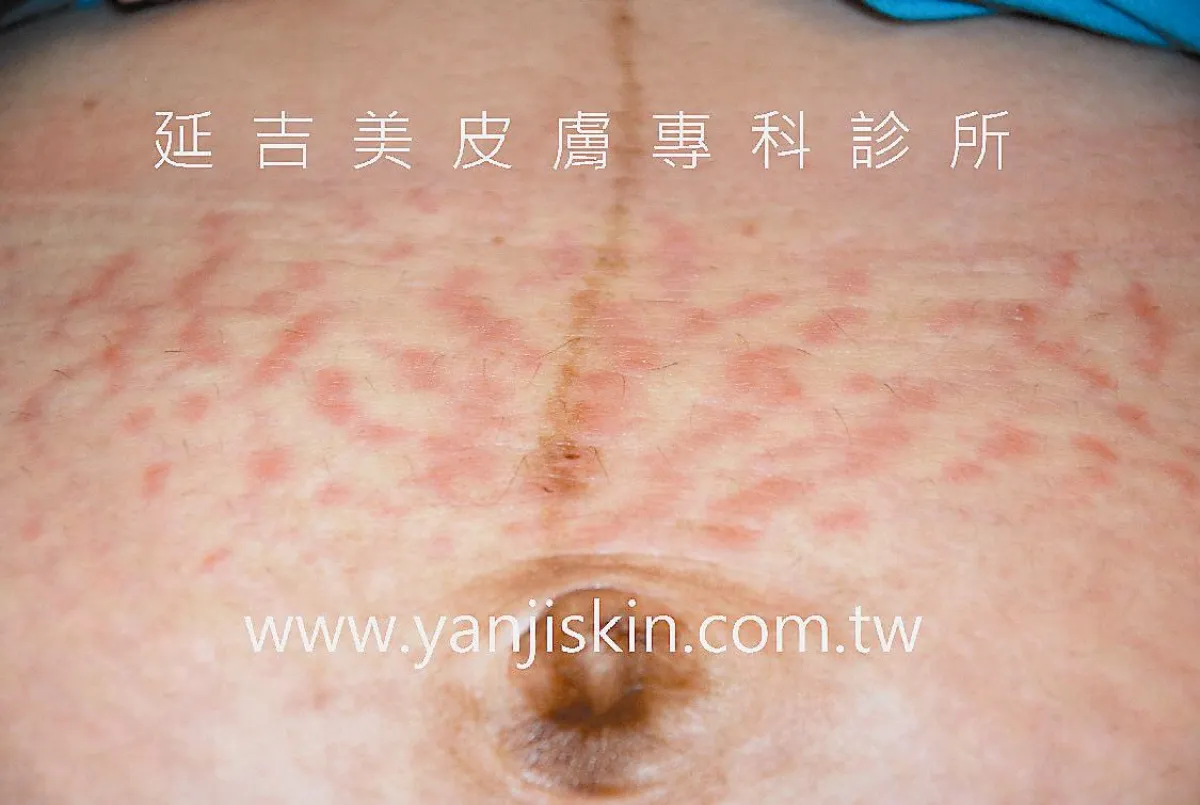 【皮膚小百科】 PUPPP奇癢無比 會自癒
