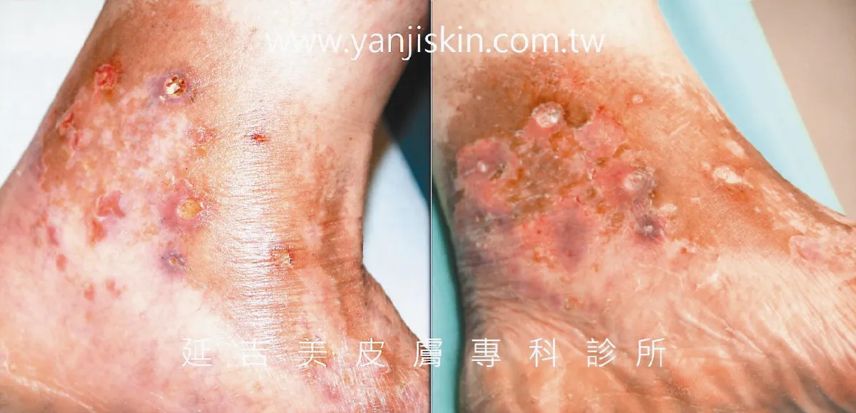 【皮膚小百科】 小腿反覆潰爛 青花狀血管炎引起