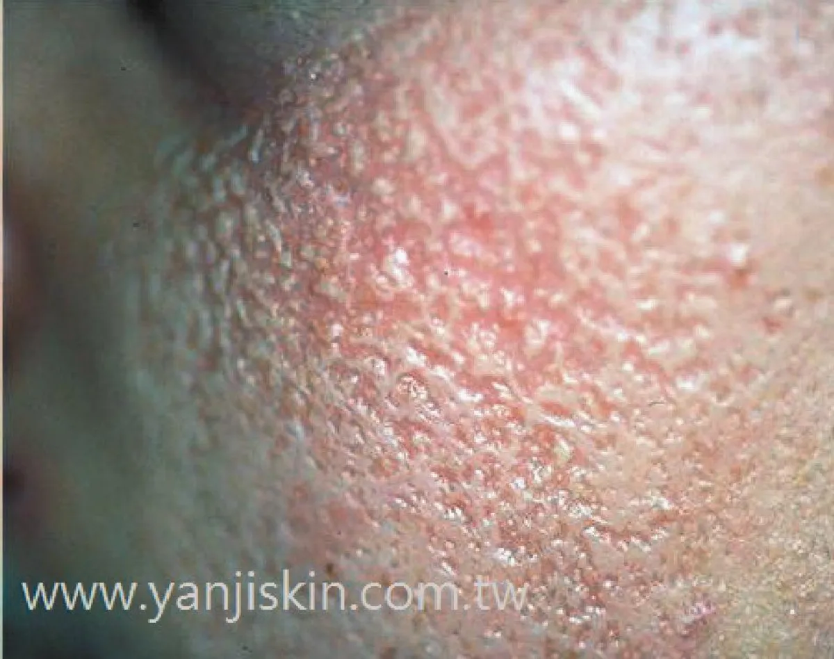 【皮膚小百科】 蟲蝕狀皮萎病 臉像風乾橘子皮