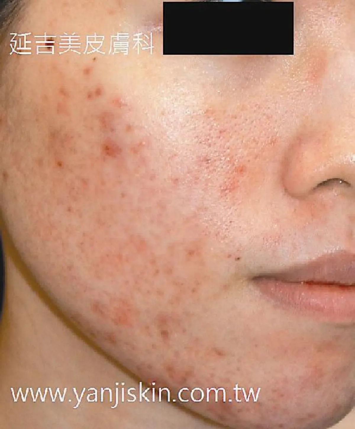 【皮膚小百科】臉常紅又敏感 不是害羞是酒糟
