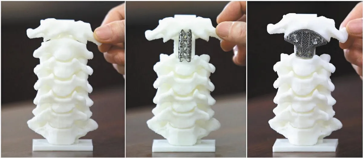 全球首例 3D列印人工脊椎