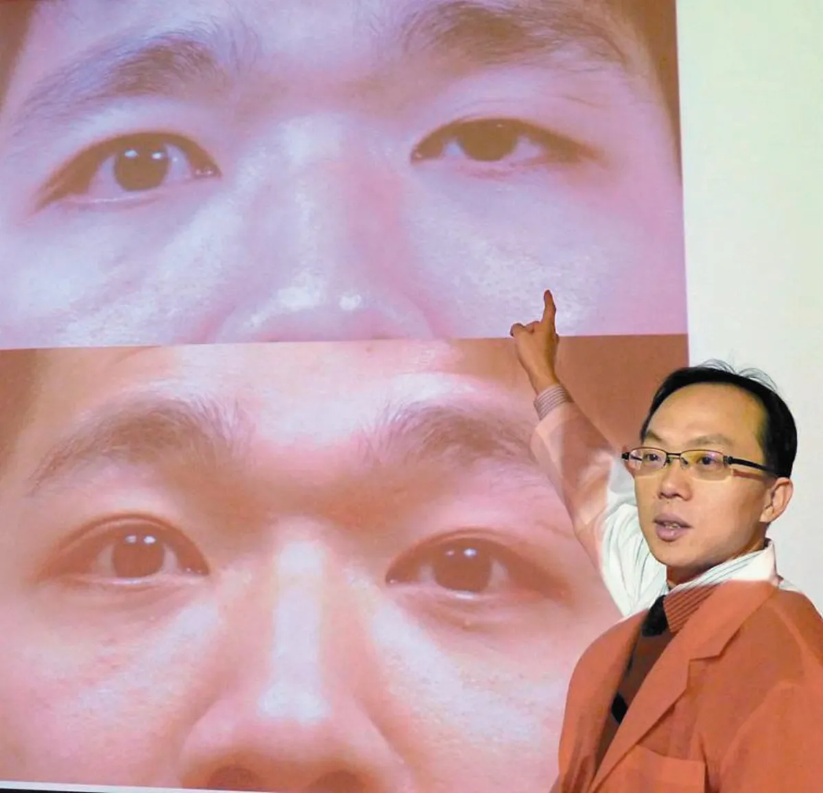 先天性眼瞼下垂  誤為打瞌睡