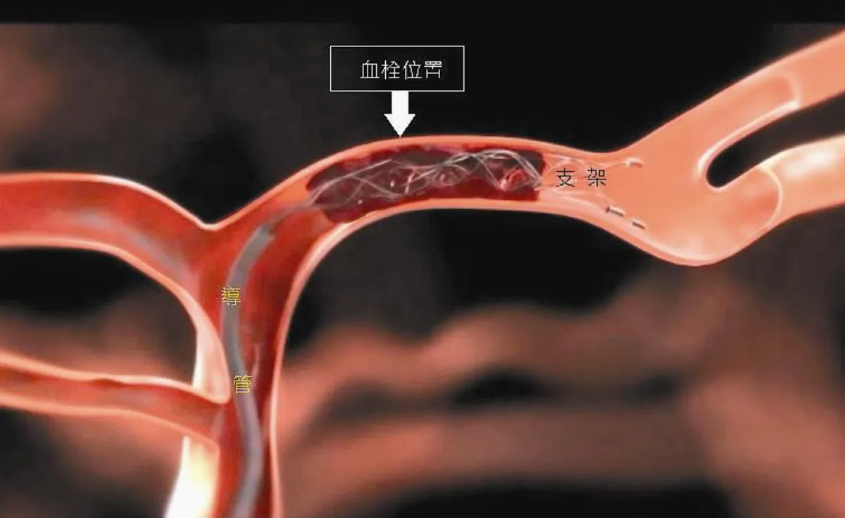 機械血栓支架 救回中風男