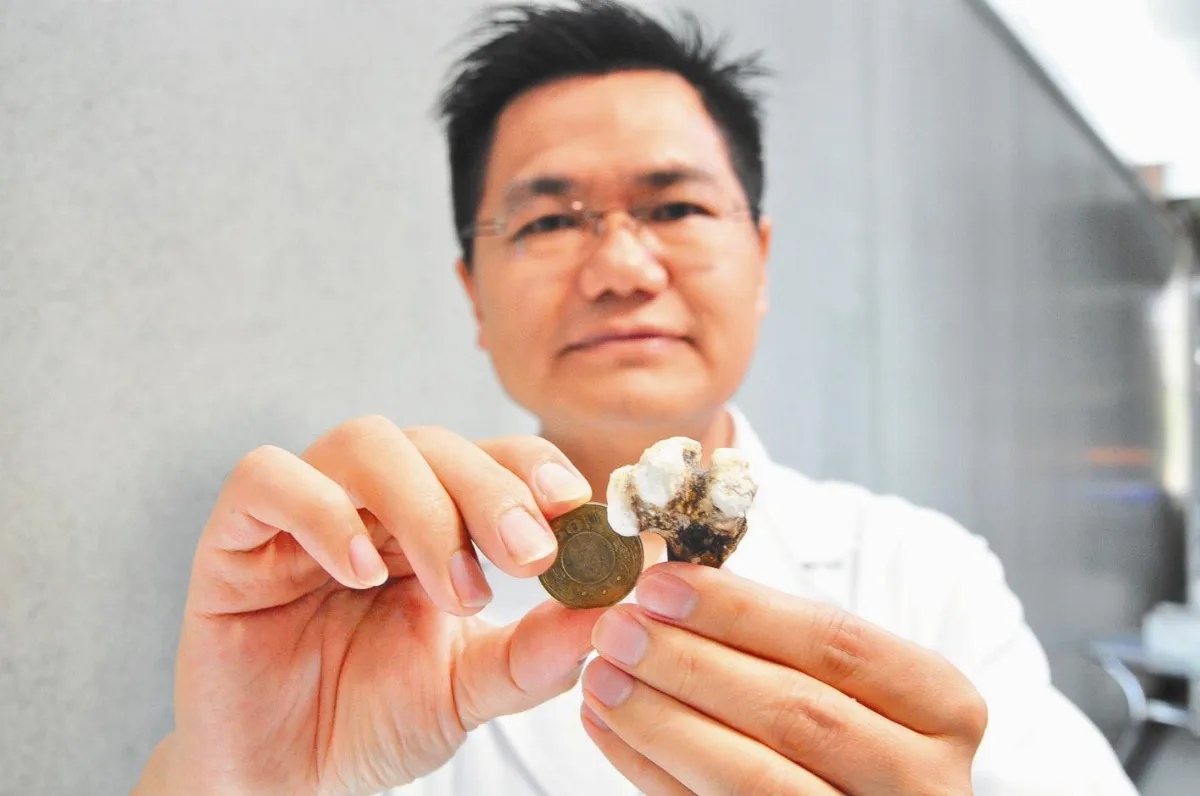 不痛不理 腎結石比50元硬幣大