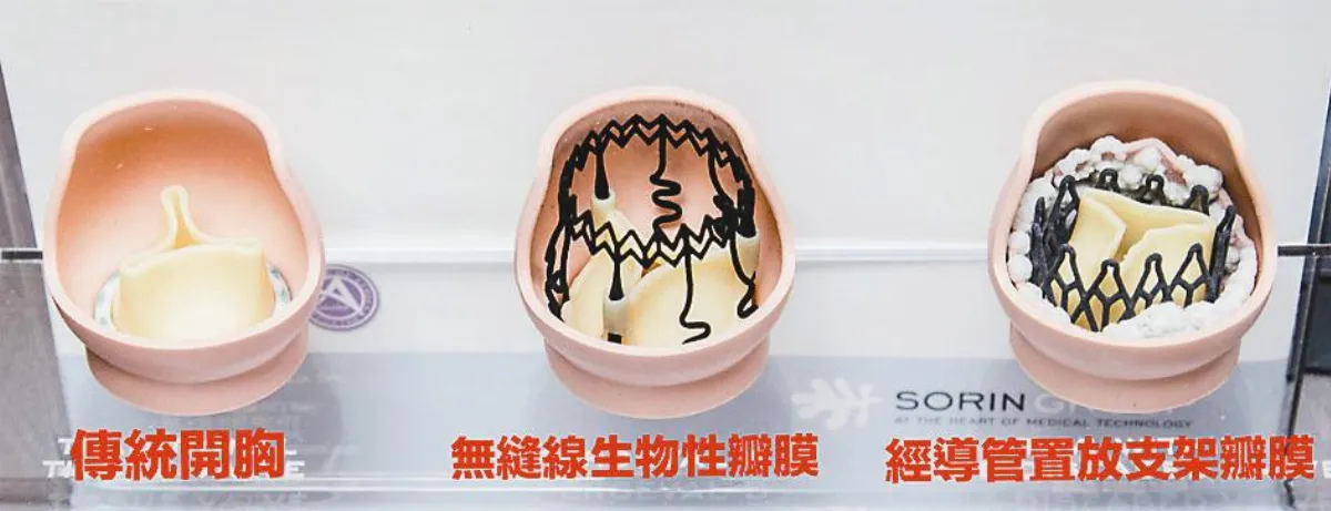 吃飯沒法喘氣 新手術重拾人生