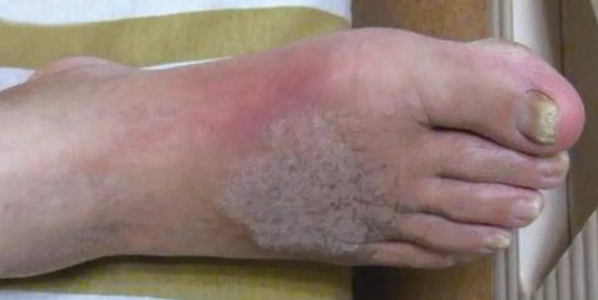 皮膚專欄  灰指甲可能引起蜂窩性組織炎？