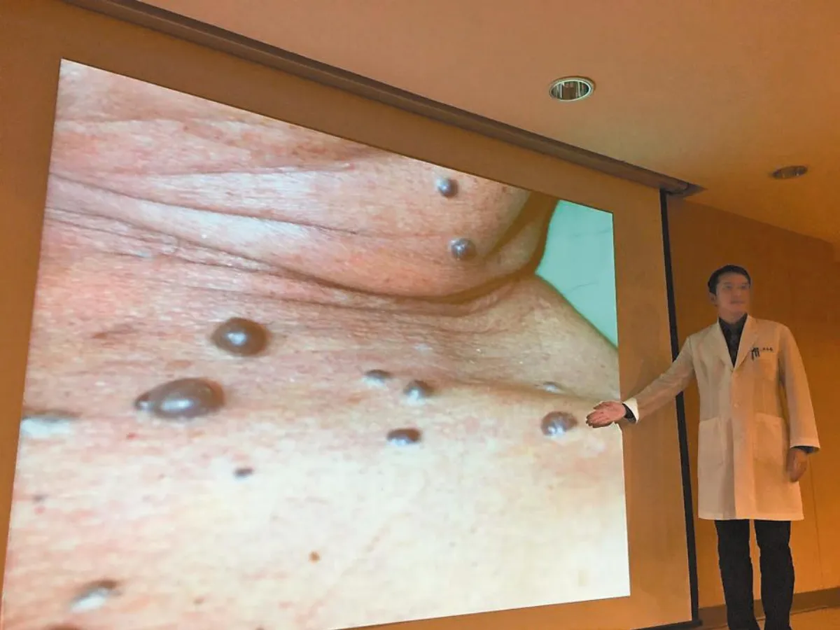 皮膚冒藍泡泡痣 恐急性腦中風
