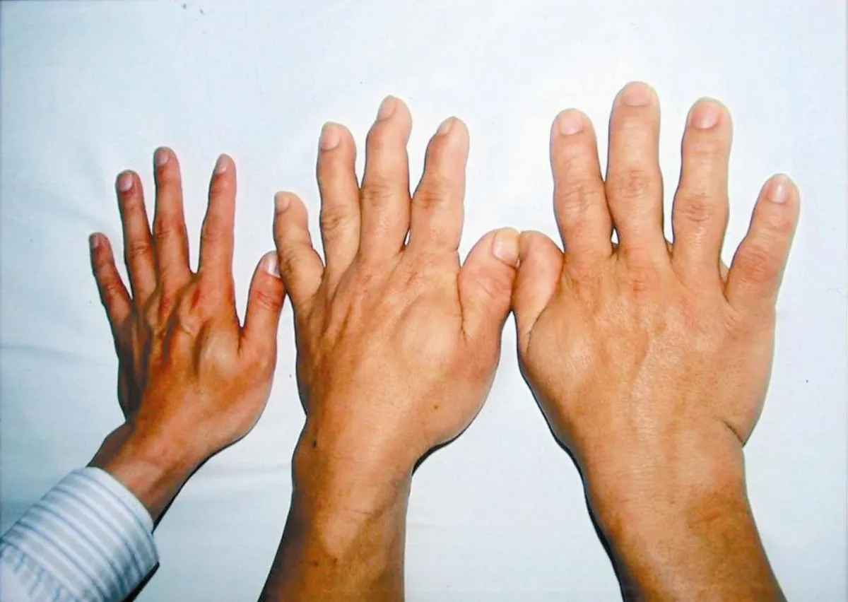 年老手腳還長大 肢端肥大作祟