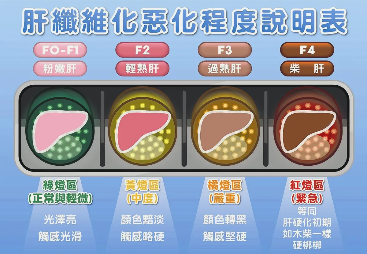 中度肝纖維化 肝癌風險6.55倍