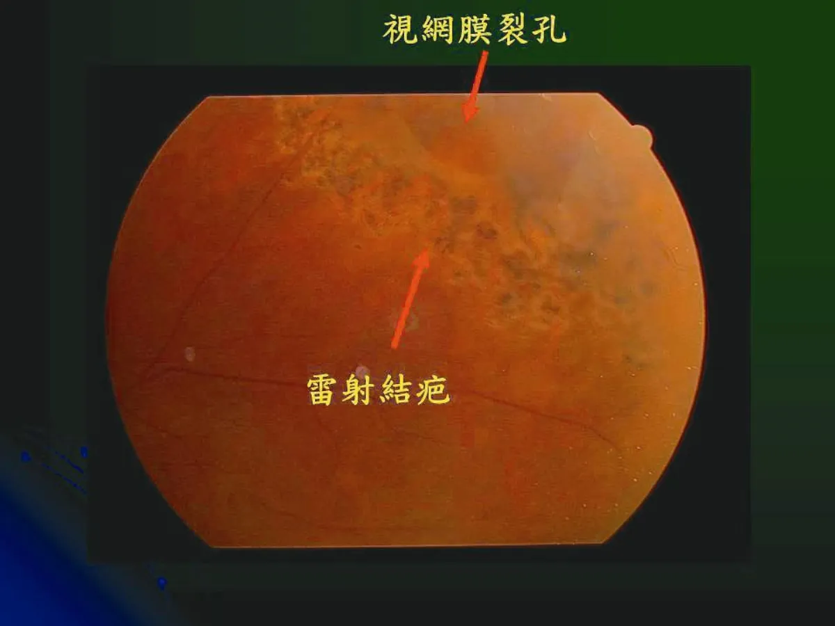 養 眼 專欄  飛蚊症：眼內的UFO（飛碟）