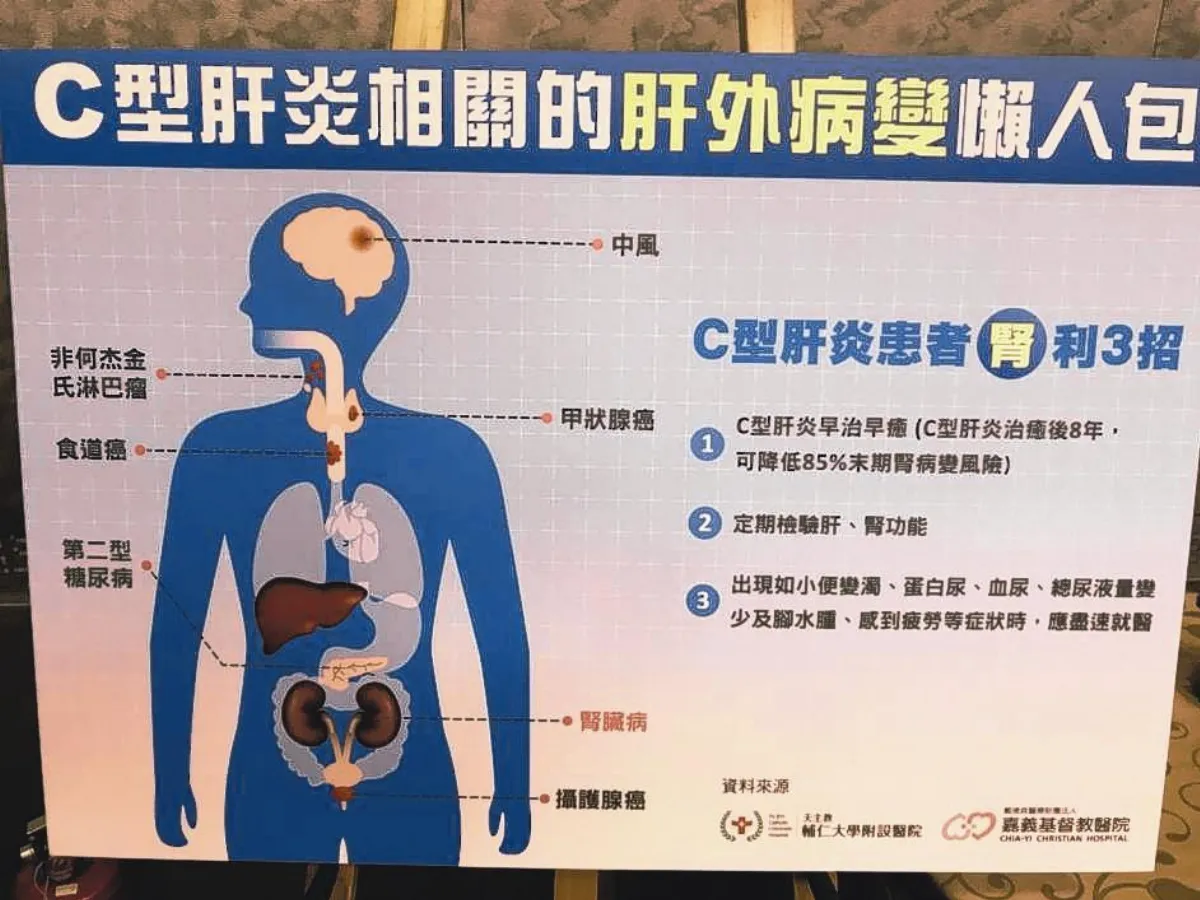 C肝積極治療 可治肝保腎