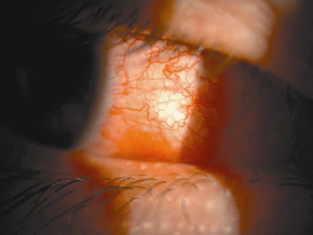 養眼專欄  眼睛的紅腫原來是黏膜變了調？！