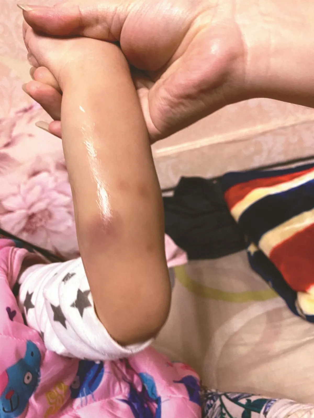 小女娃多處瘀青  原來罹罕病