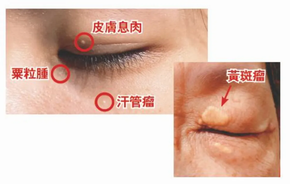 眼周小顆粒有3種 體質造成擦藥無效