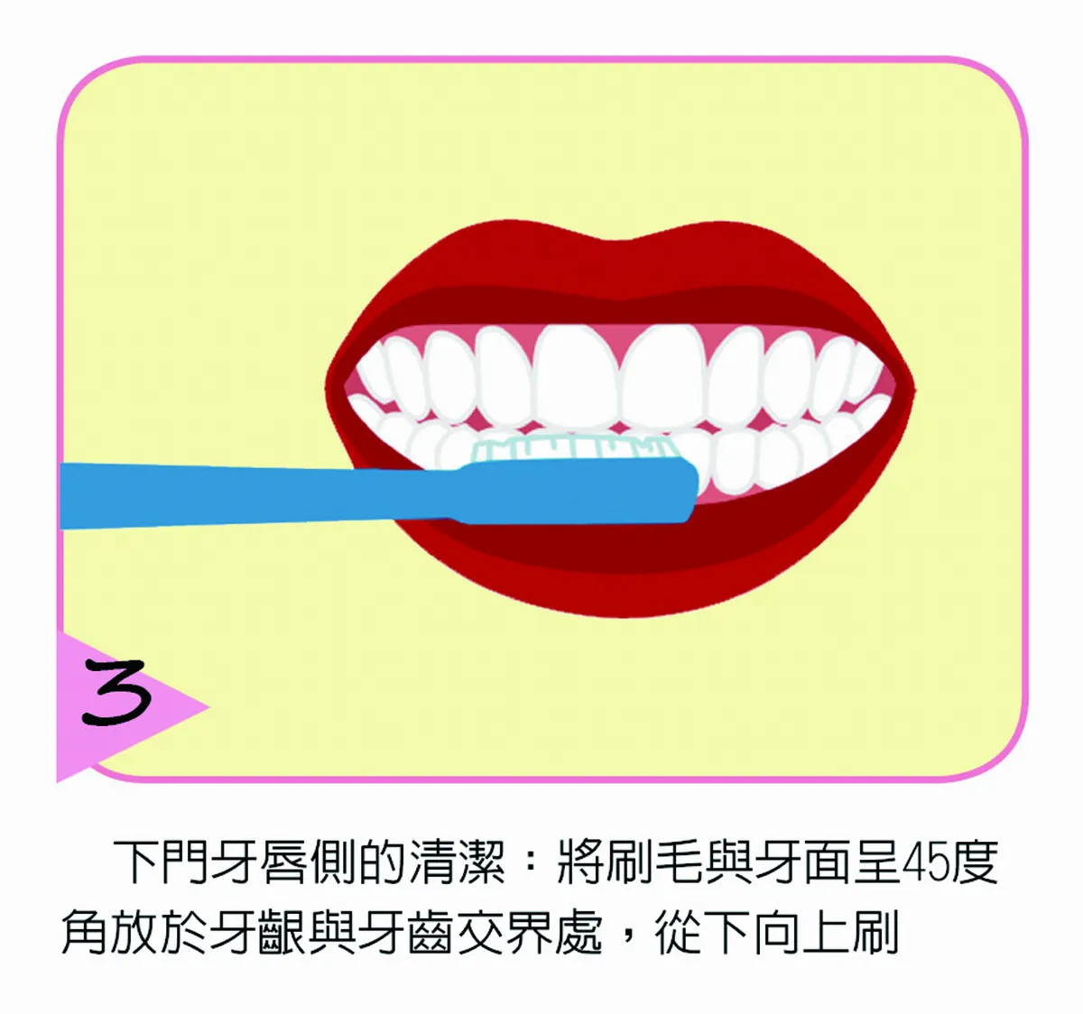 人類第三副牙齒 種植牙
