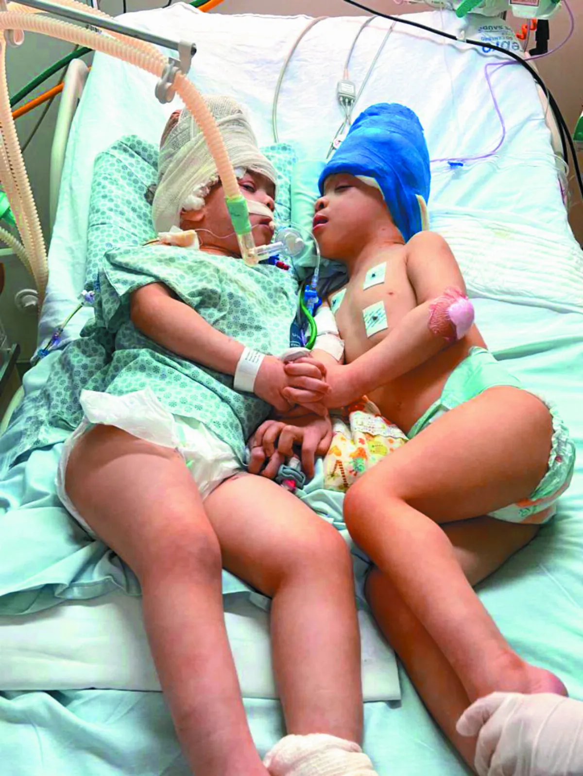 VR技術助攻  巴西頭部連體嬰分離