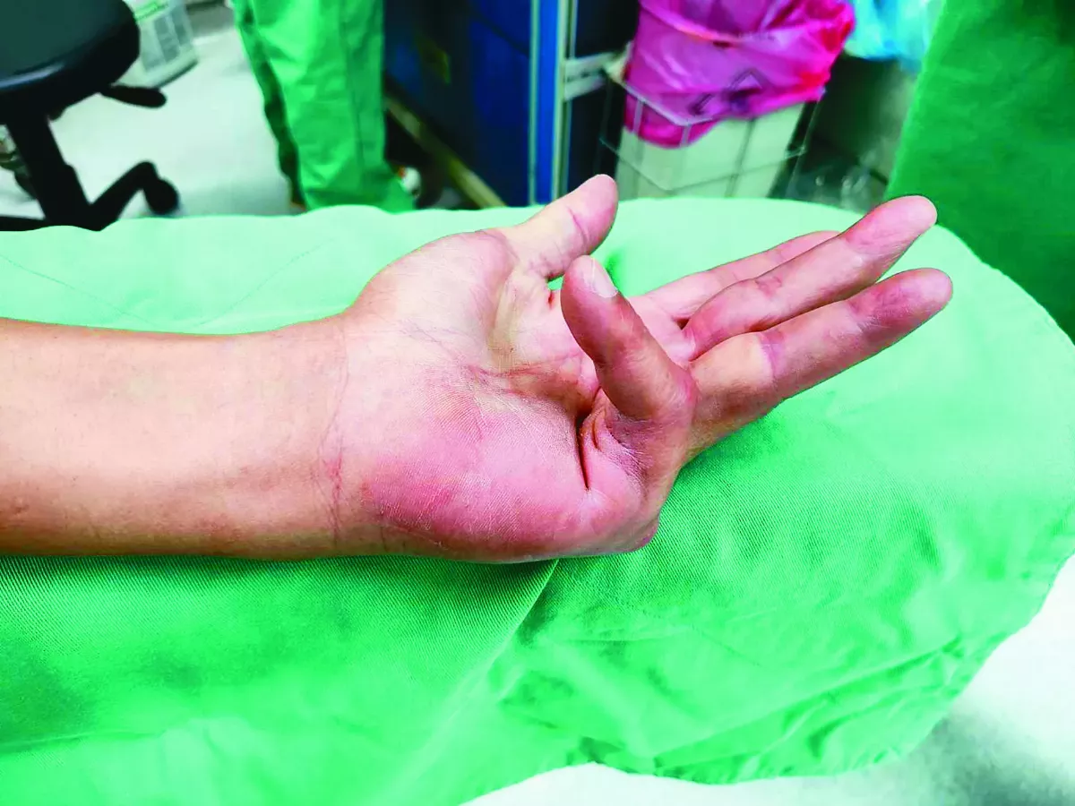 掌腱膜攣縮症 針挑手術具療效