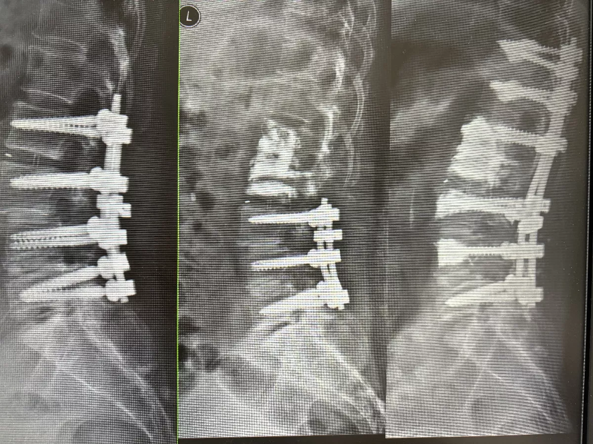 7年4次腰椎手術　翻修手術讓婦女重獲生機