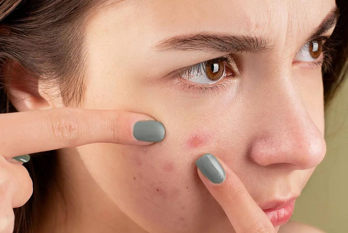 只要青春不要痘疤 補眠、補水加補C