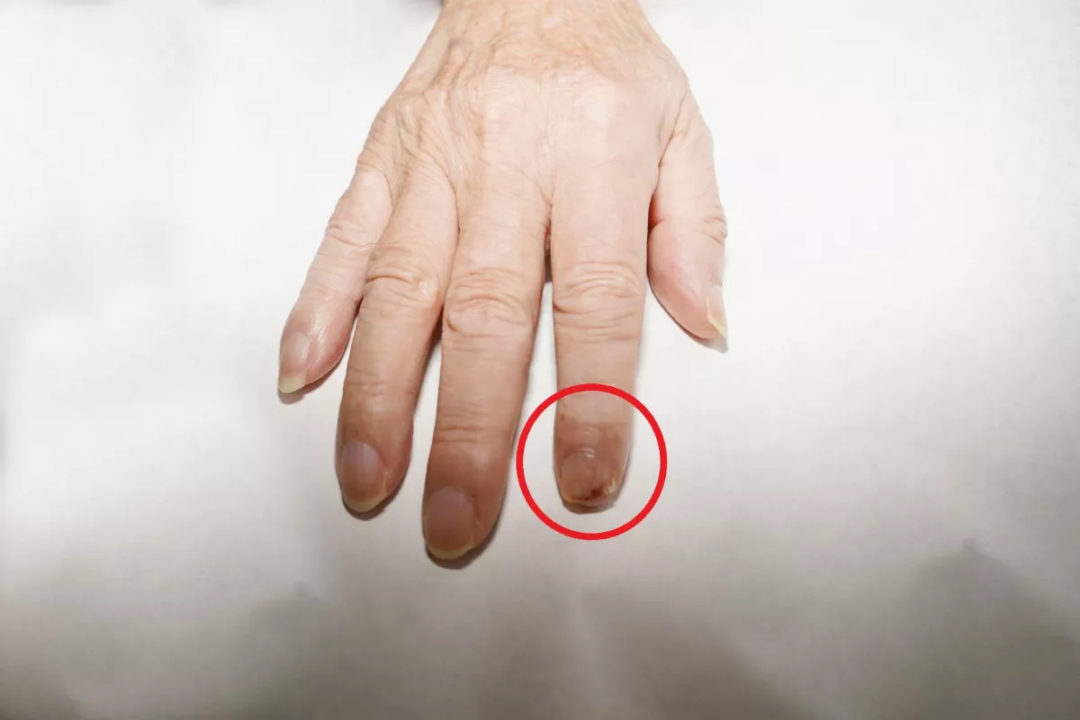 指甲常疼痛腫脹、傷口難癒 小心皮膚癌上身