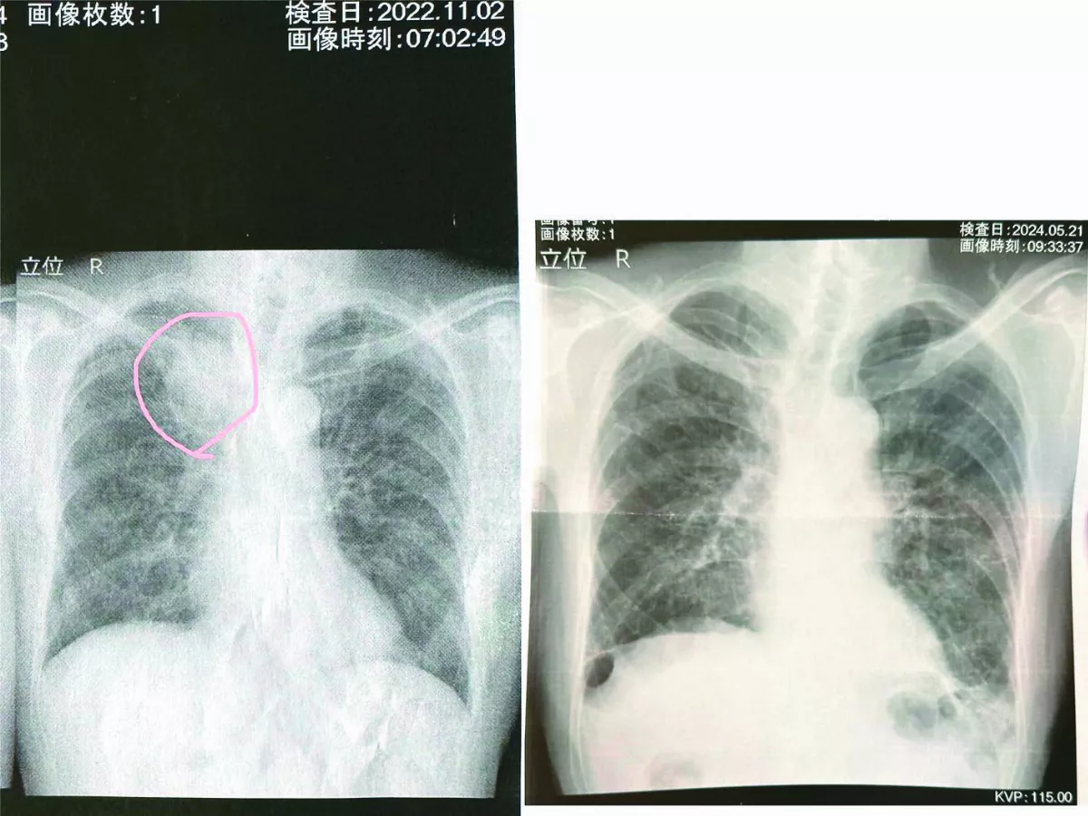 孫陪角色扮演 癌末爺奇蹟好轉
