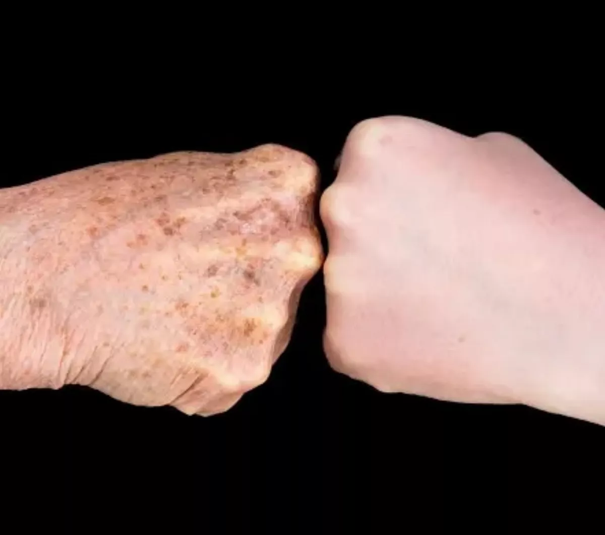 對抗紫外線不到位　男大生晒出老人斑