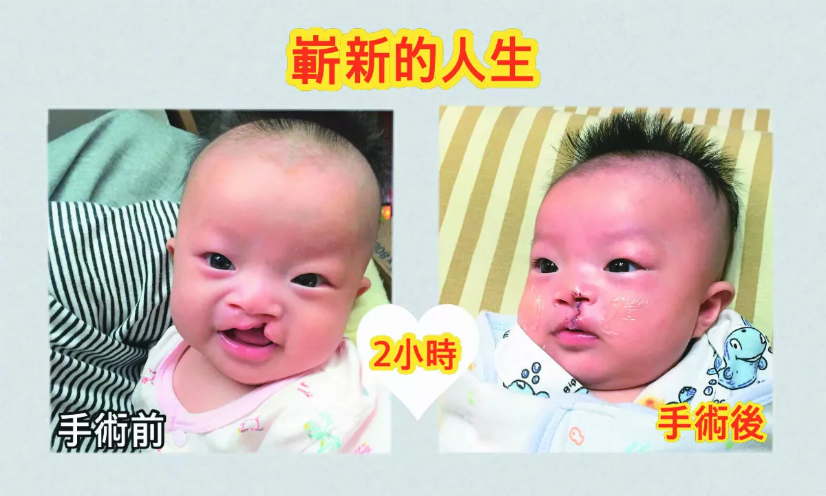 家有顱顏缺陷兒 用愛建立自信心