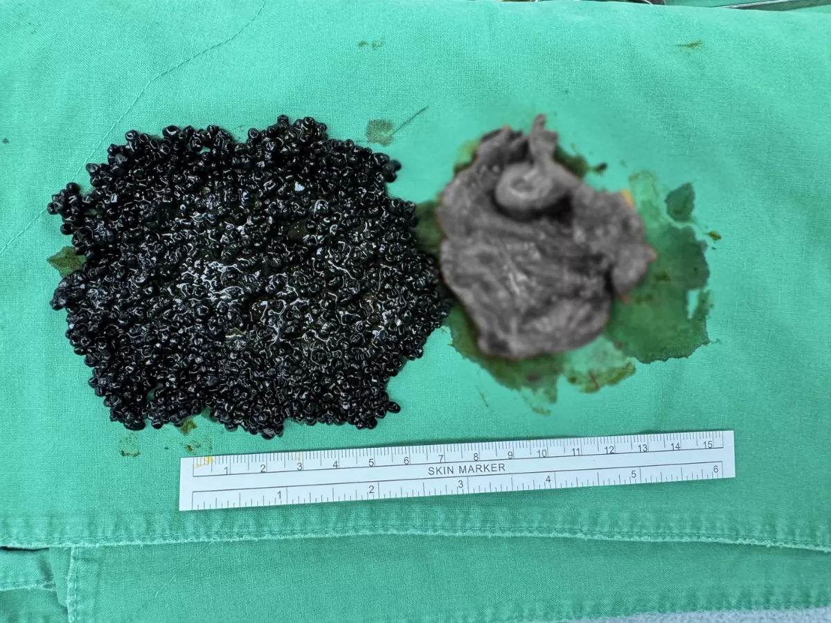 大啖火鍋後喊腹痛  千顆烏亮黑珍珠塞爆膽囊