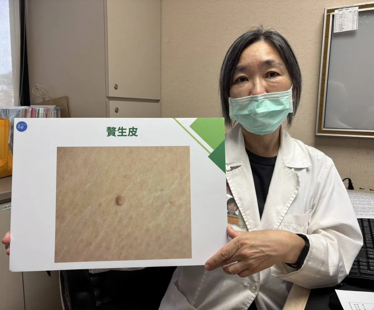 「贅生皮」莫輕忽 醫：避免併發症