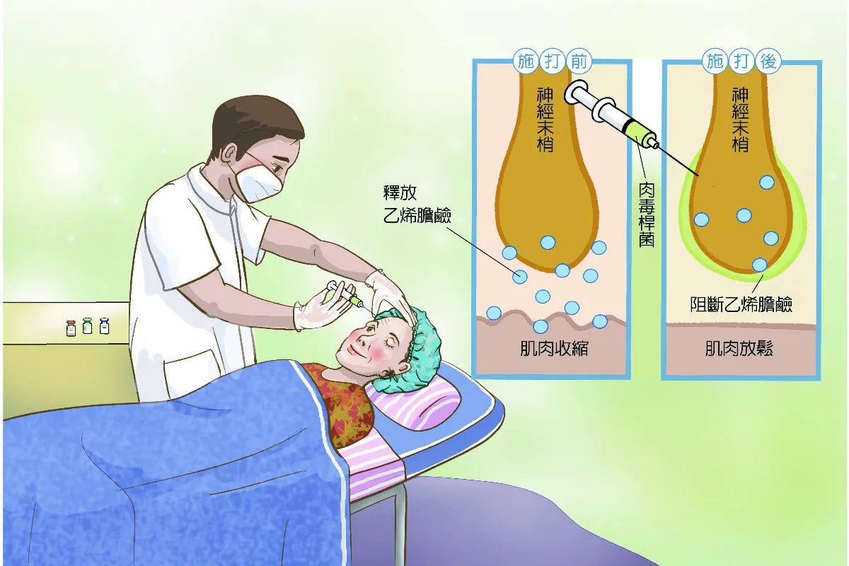 毒素製成美容劑