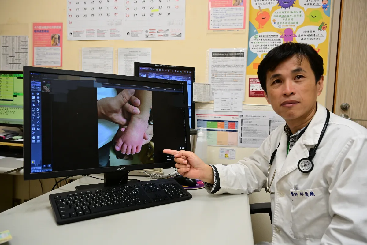 高燒紅眼手腳腫 2歲童川崎病上身