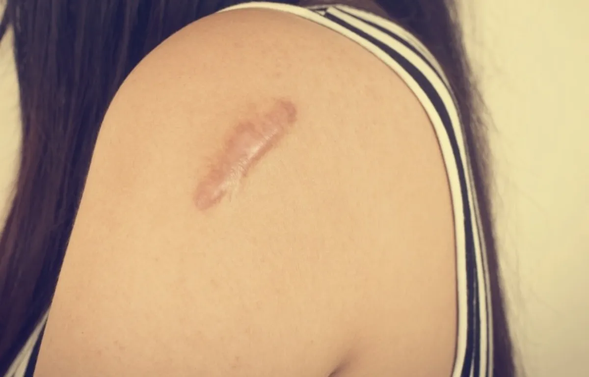 凸疤愈長愈大還會痛  蟹足腫反覆擴散難根治