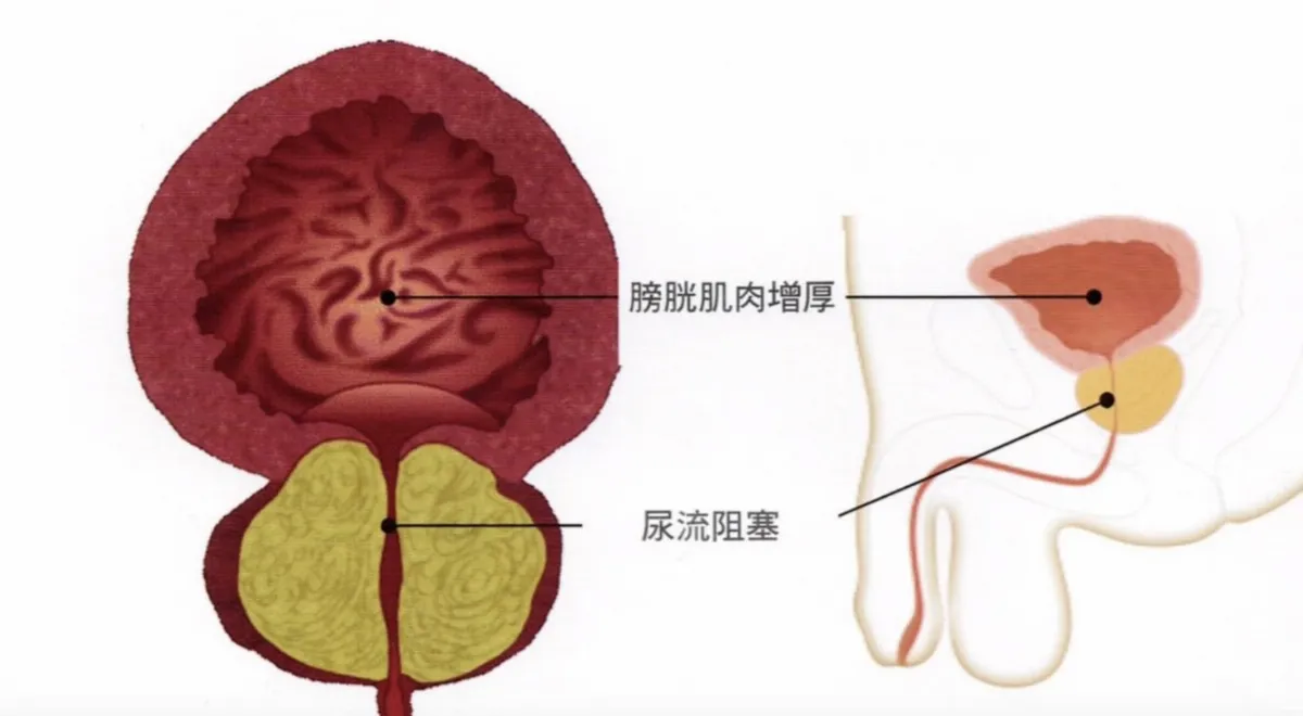 輕忽血尿 高齡男性膀胱內積存鮮血險送命