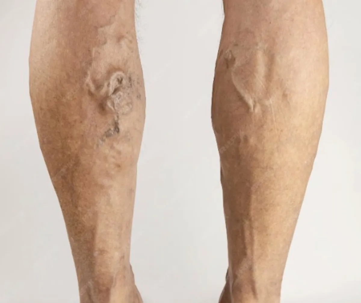 腿爆青筋靜脈回流差惹禍 鬱積性皮膚炎恐潰瘍