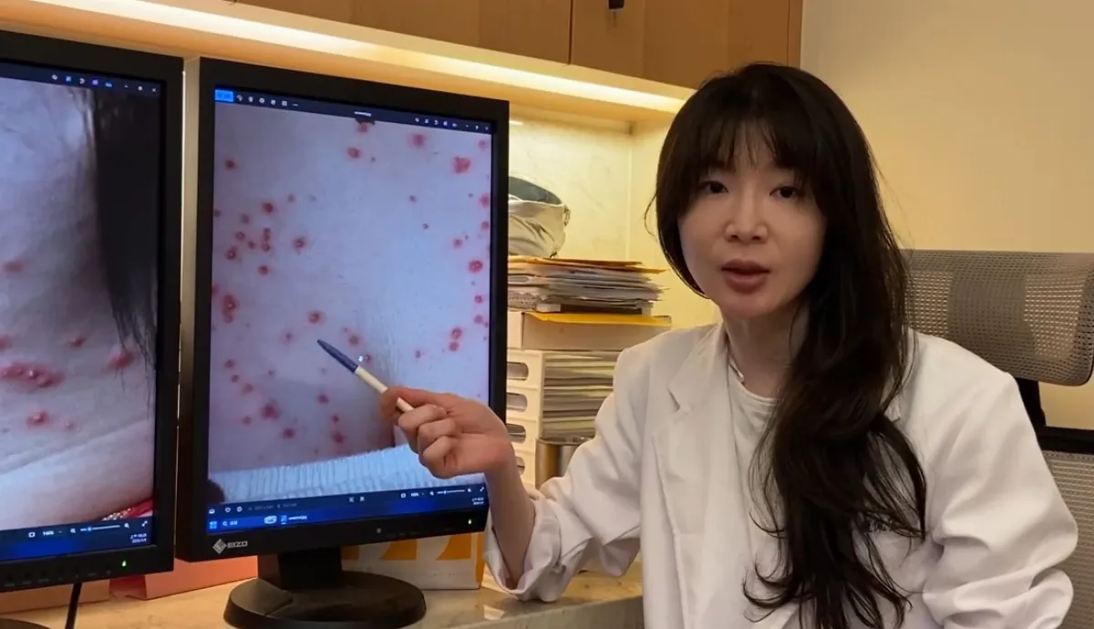 溼疹痘痘易混淆 醫：亂擦藥膏恐傷皮膚內分泌